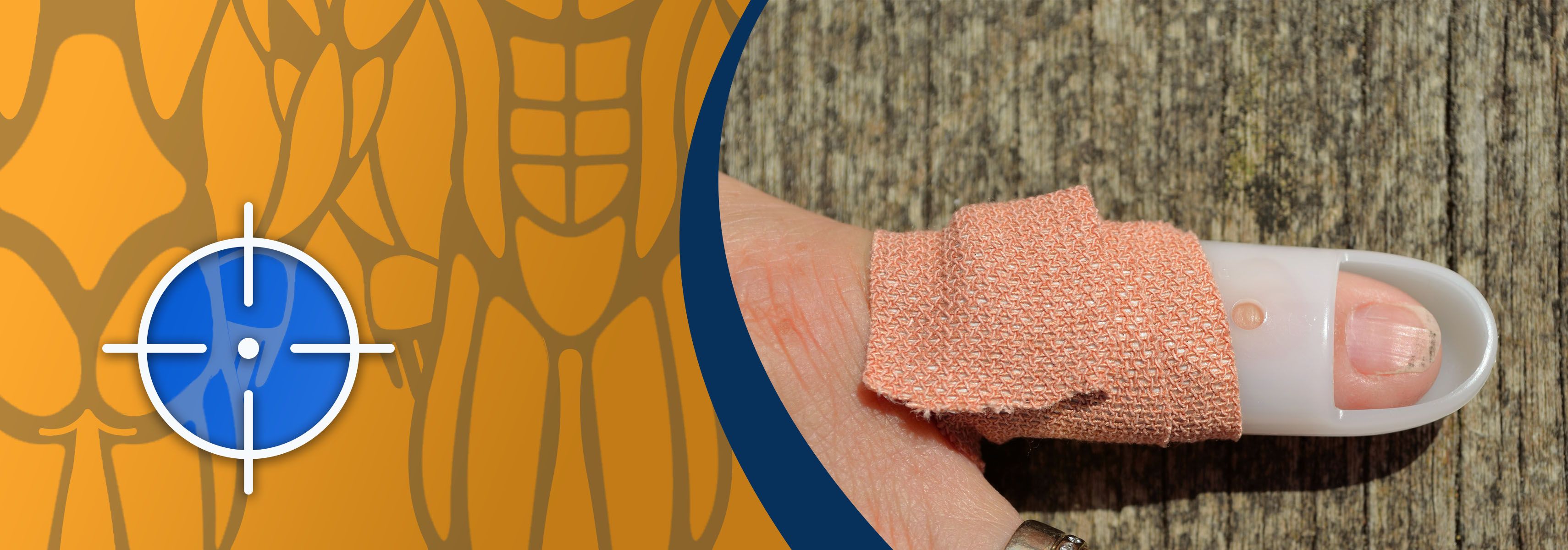 Was ist ein Schlägelfinger