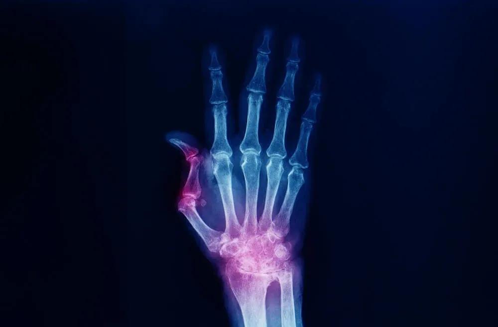 thumb brace osteoarthritis