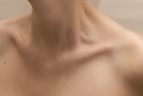 collarbone arthritis