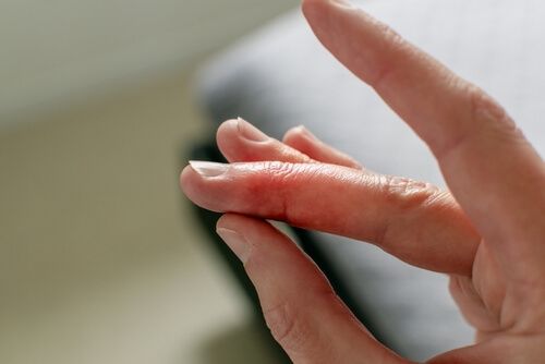 hammerfinger behandlung