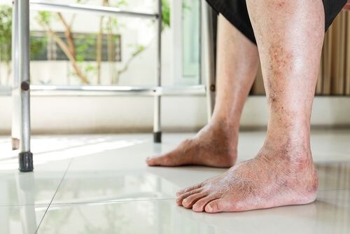 varicose veins ankle