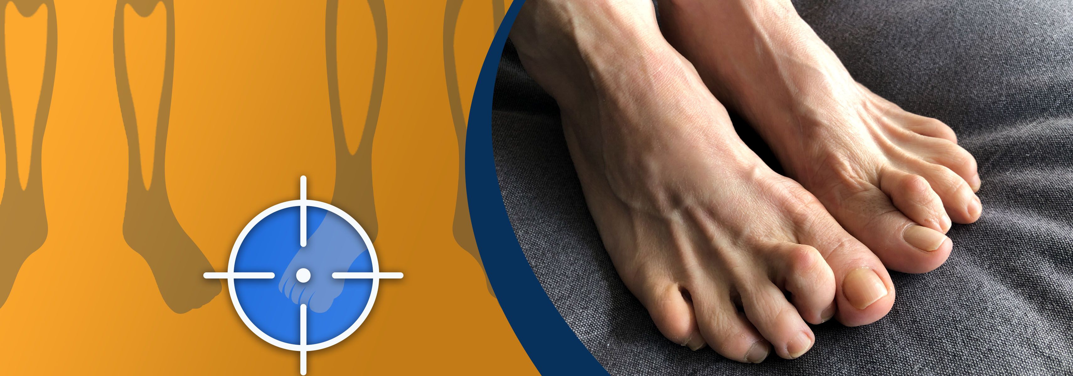 what are hammer toes, and how do i get rid of them