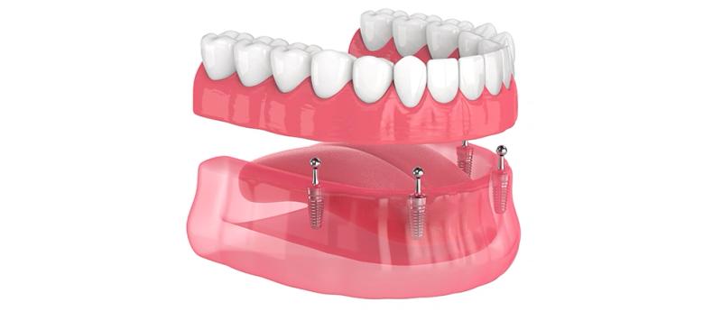 Implant-Supported Dentures