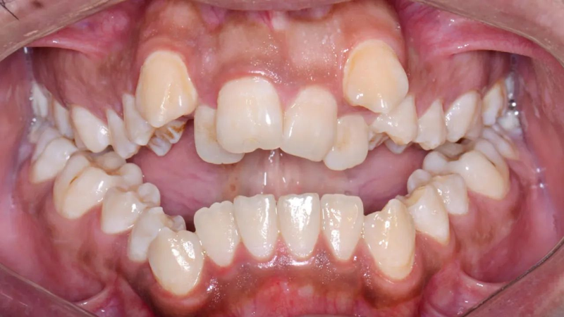 Dental Braces Treatment