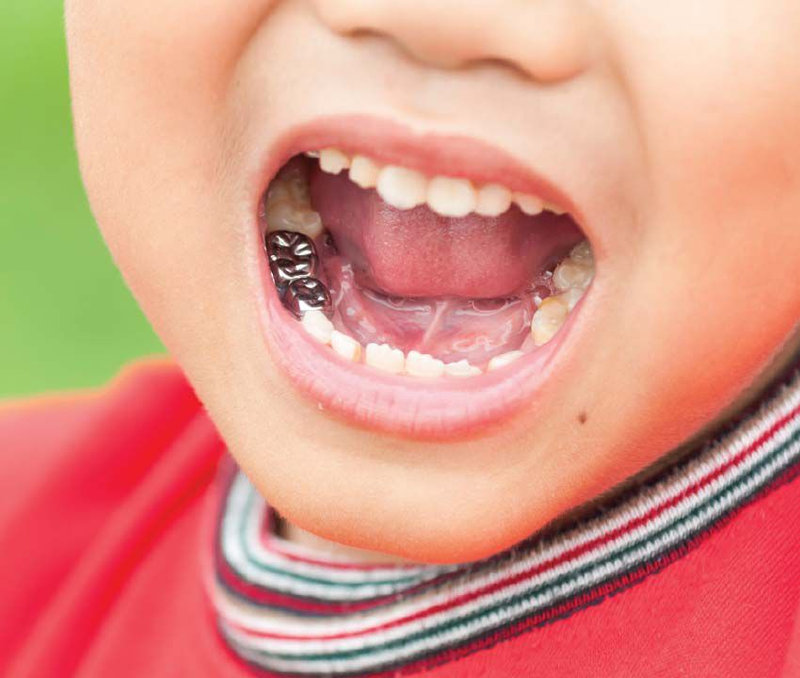 Children's Dental Crown