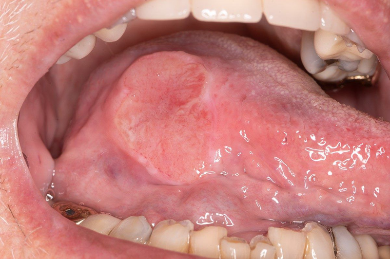 Oral Cancer & Tumor Biopsy
