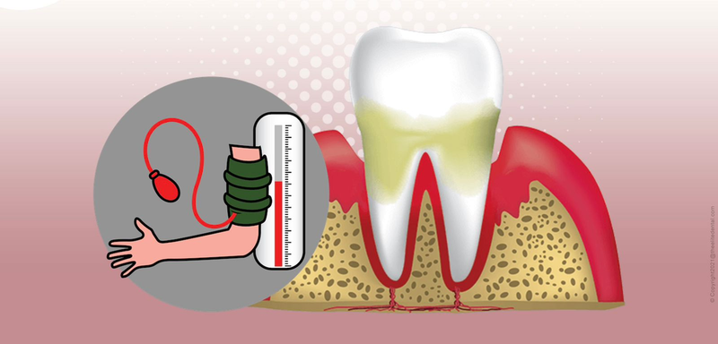 Dental Treatment for Hypertension Patients