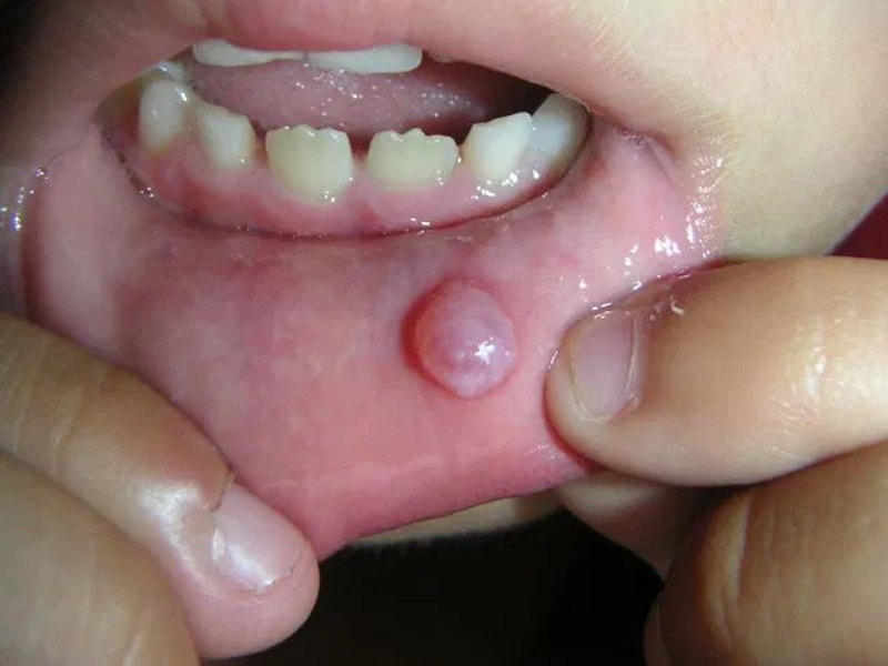 Salivary Gland Swelling Treatment