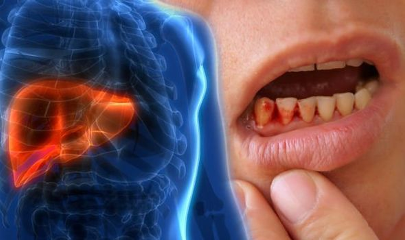 Dental Treatment for Liver Patients