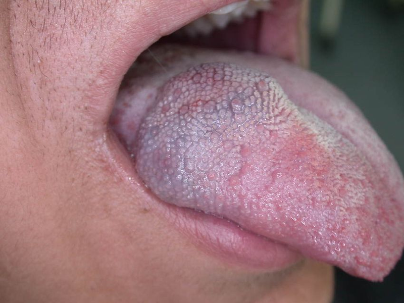 Oral Blood Vessel Swelling Treatment