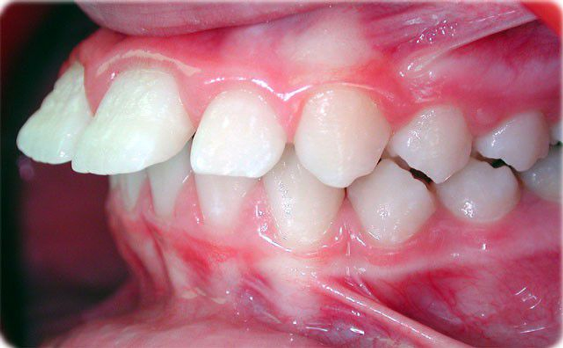 High Tooth Leveling