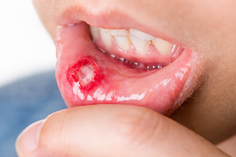 Any Type of Oral Infection Treatment