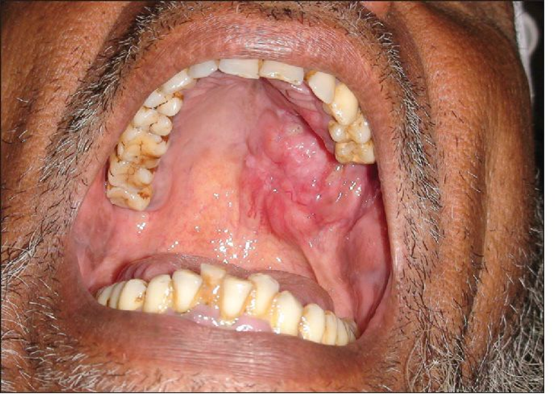 Palate & Maxillary Sinus Cancer Treatment