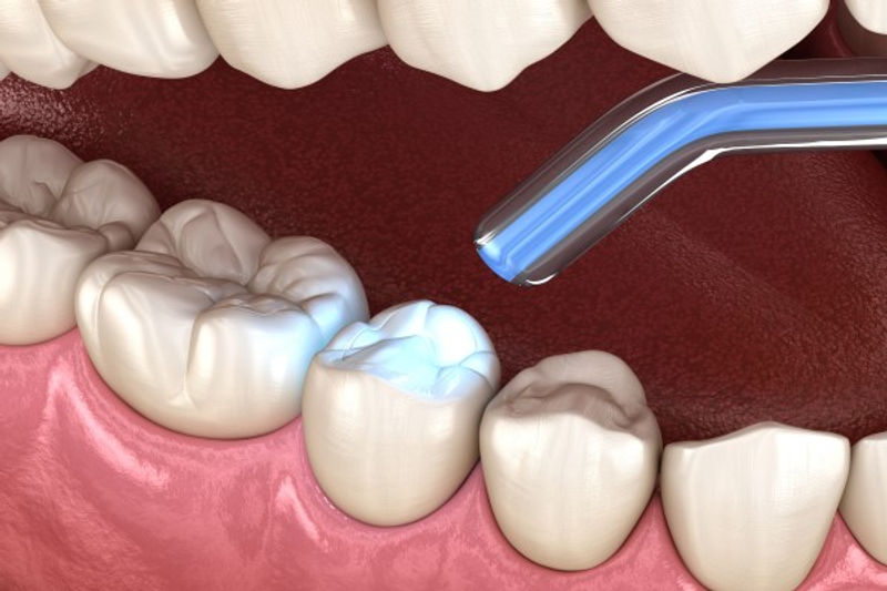 Tooth Filling