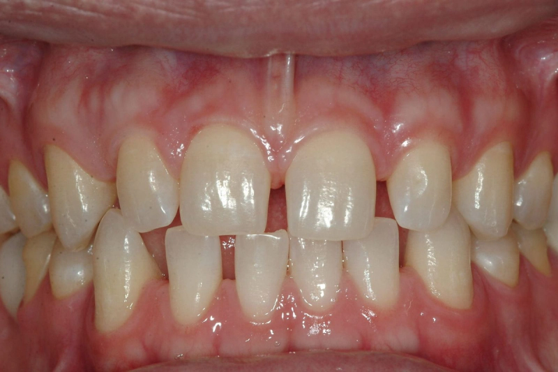 Gap Closure / Teeth Spacing Correction