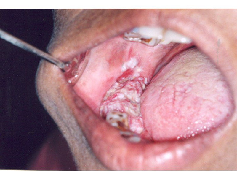 Oral & Jaw Bone Cancer Treatment