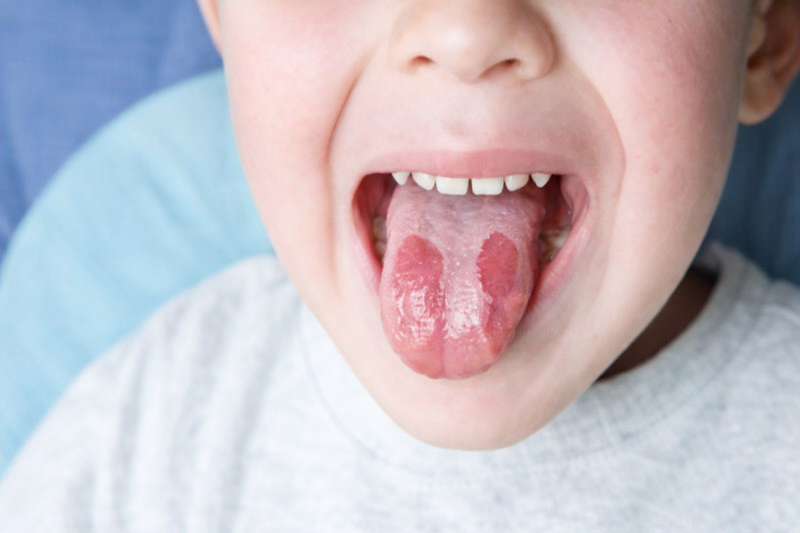 Burning Mouth Syndrome Treatment