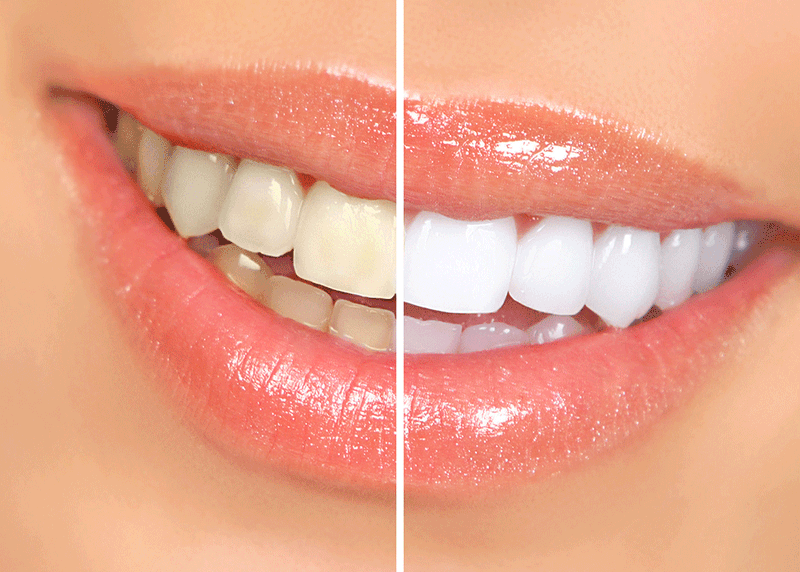 Teeth & Gum Whitening