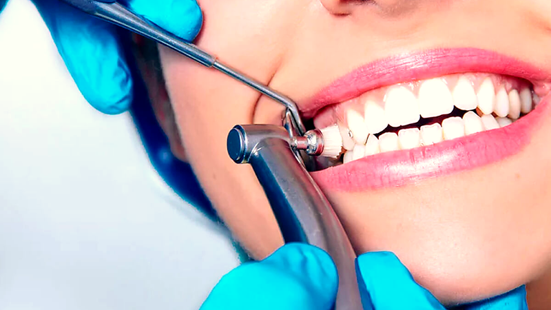 Dental Scaling & Polishing