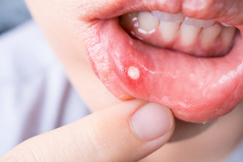 Oral Ulcer & Wound Treatment