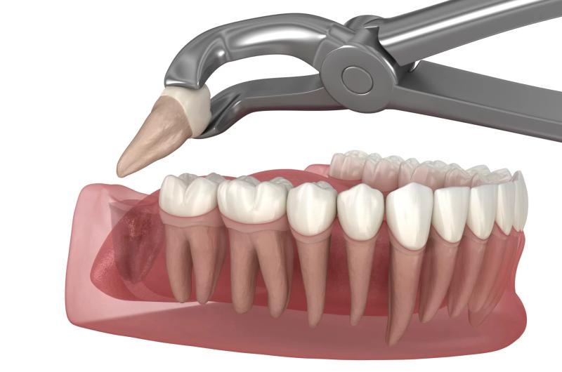 Tooth Extraction