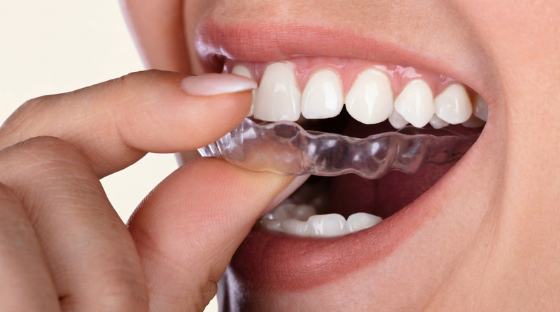 Occlusal Splint for Tooth Erosion Prevention