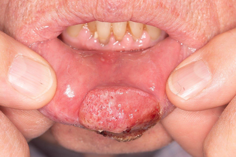 Lip, Cheek & Tongue Cancer Treatment