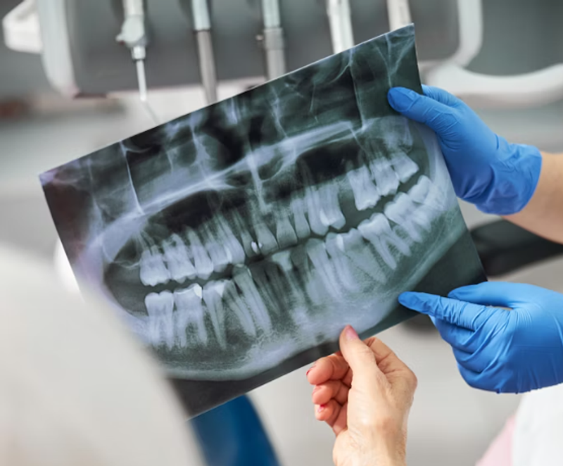 Dental X-Ray & OPG