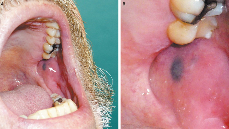 Oral Pigmentation & Discoloration Treatment