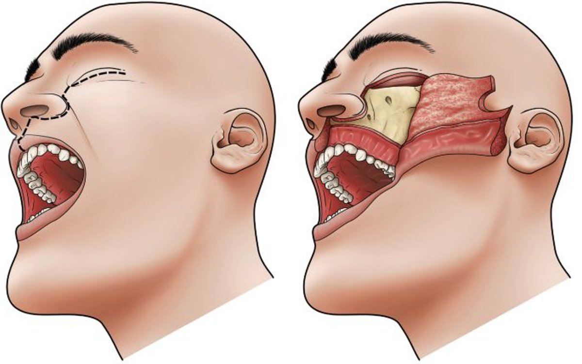 Tooth, Gum & Jaw Cancer Treatment