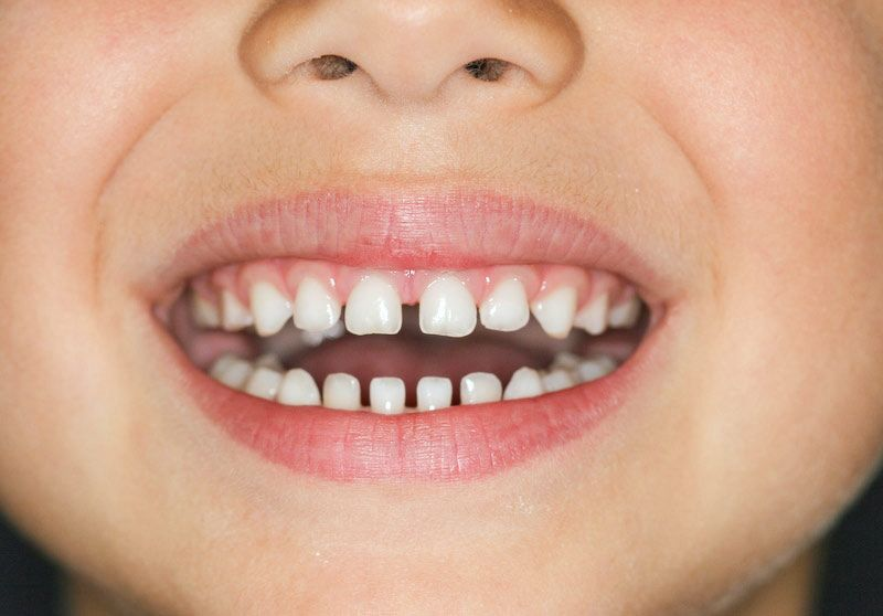 Pediatric Gap Tooth Treatment