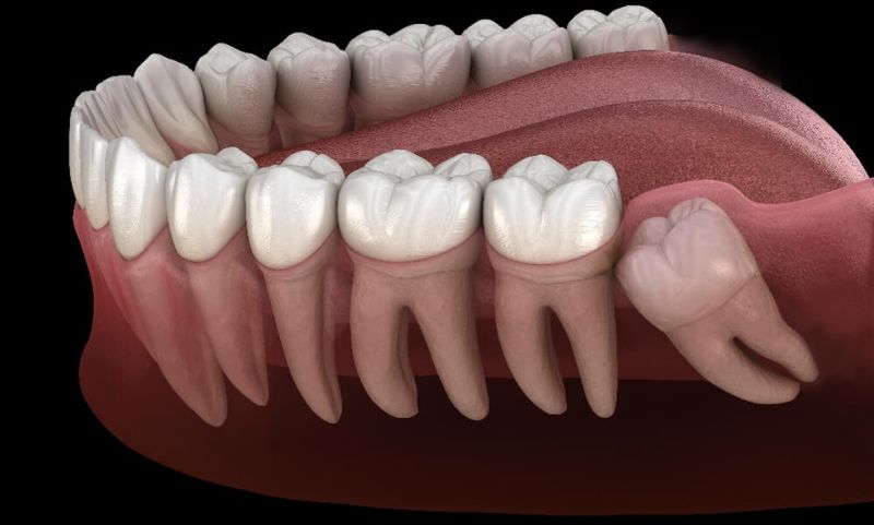 Wisdom Tooth Treatment