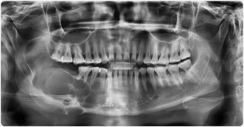Oral & Jaw Bone Cyst & Tumor Treatment