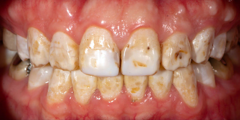 Congenital Dental Defect Treatment
