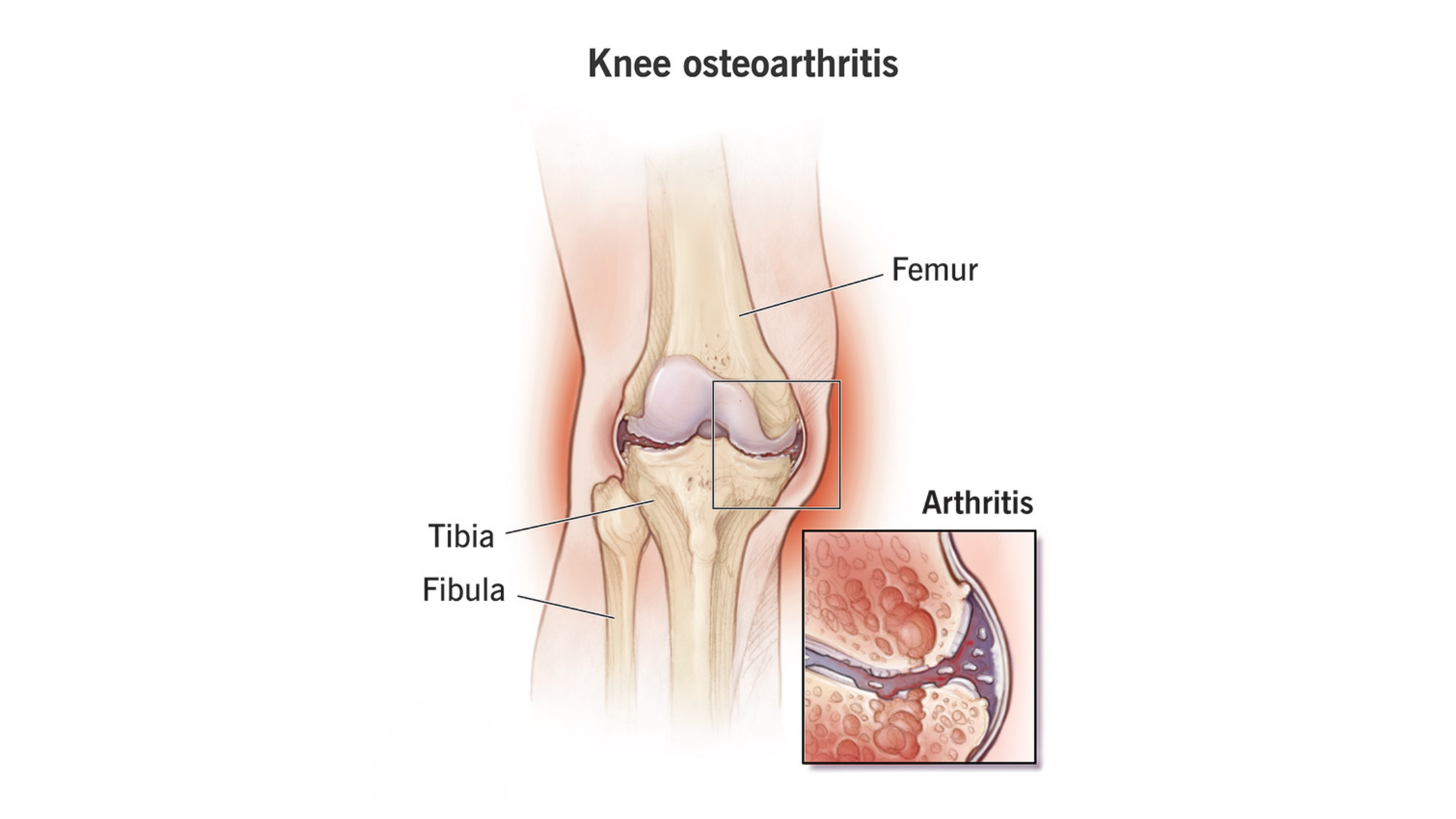 Knee osteoarthritis causing knee pain and stiffness explained by Dr. Hithesh