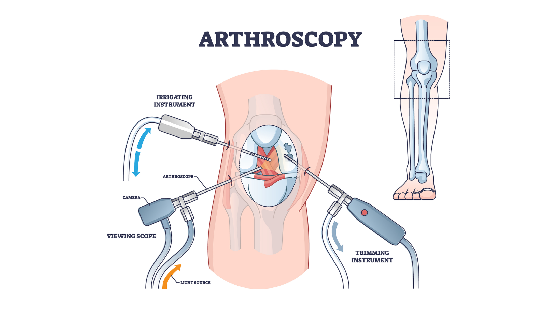 Dr. Hithesh explaining knee arthroscopy procedure and recovery