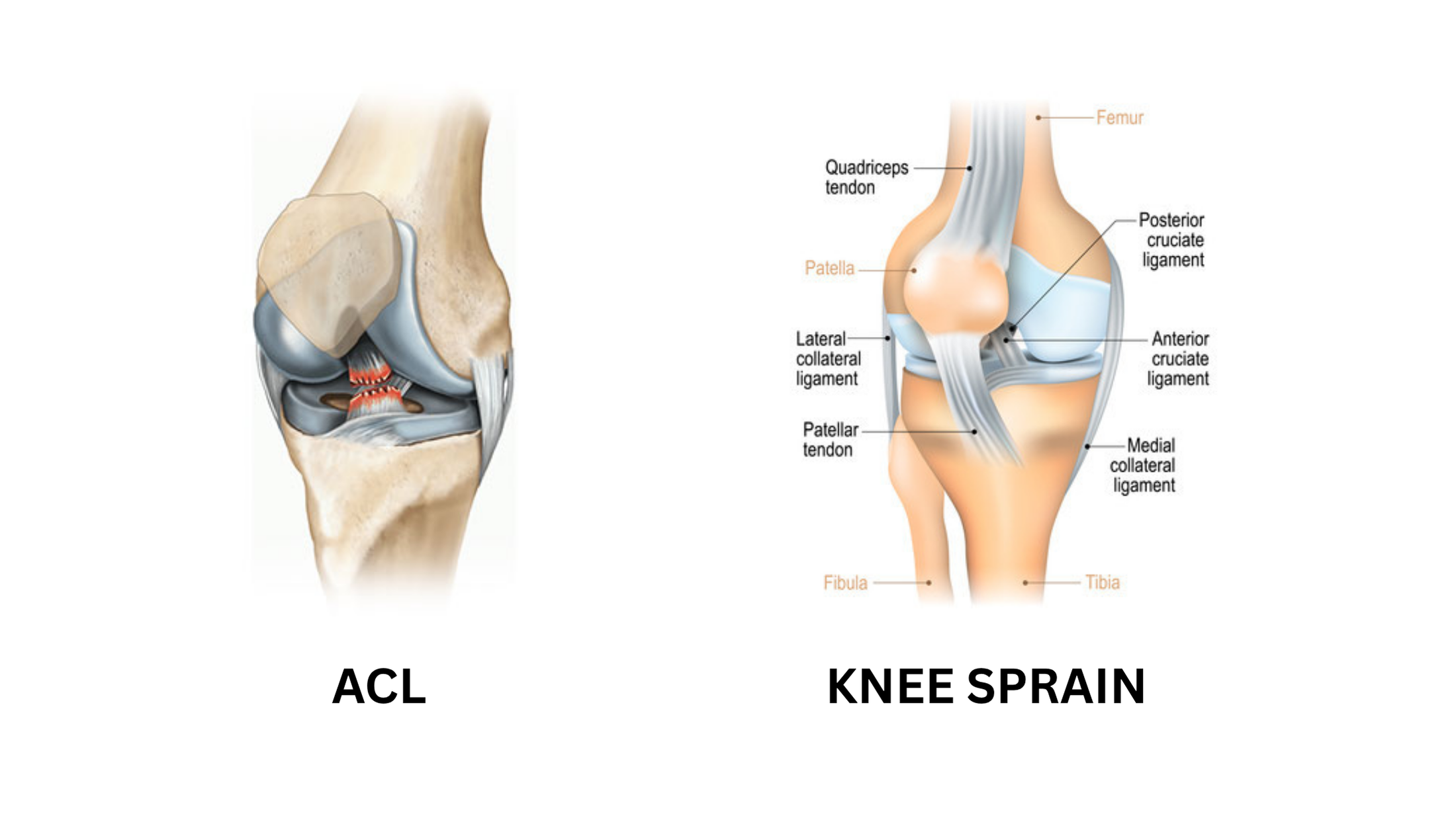 Dr. Hithesh explaining ACL tear vs knee sprain symptoms and treatment