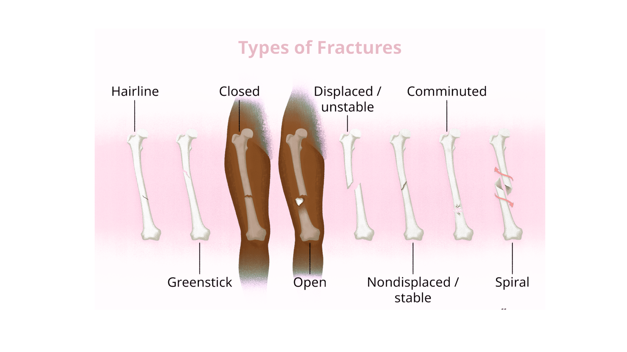 Dr. Hithesh explaining different types of bone fractures and bone fracture treatment