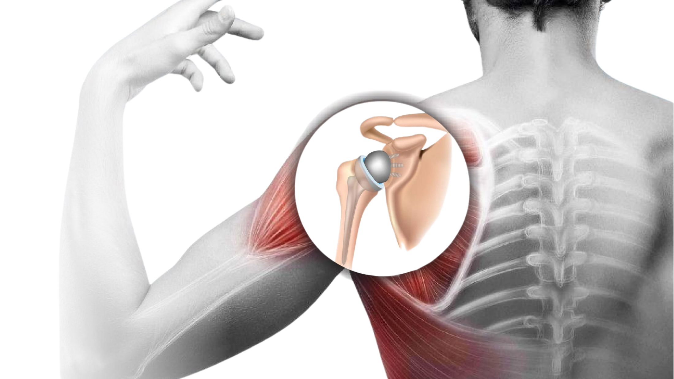 Dr. Hithesh explaining shoulder replacement surgery and recovery