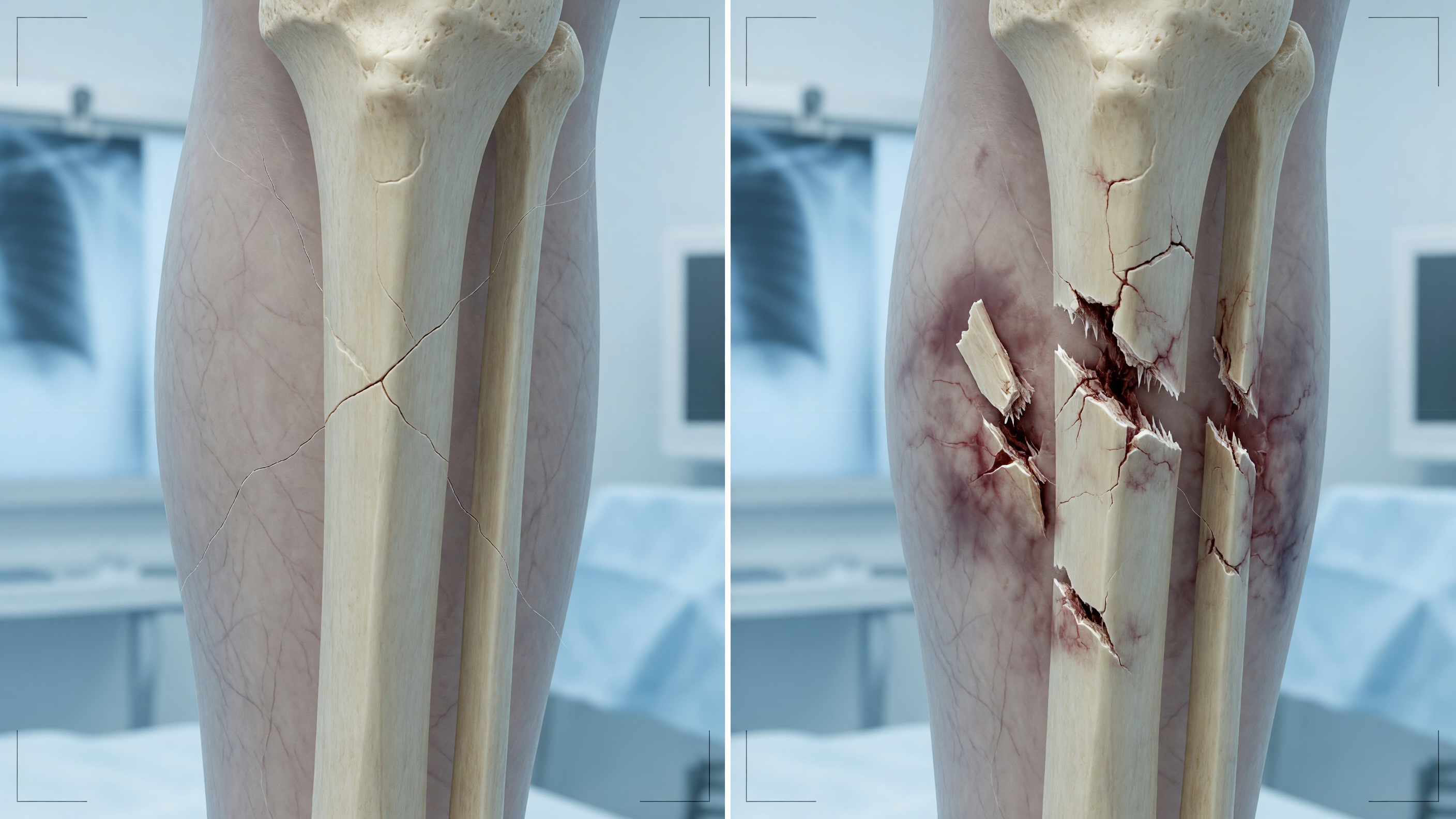 Illustration comparing hairline fracture vs complete fracture in a bone X-ray