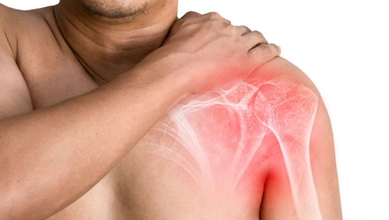 Shoulder dislocation treatment by Dr Bathini Hithesh shoulder surgeon using Bankart stabilisation