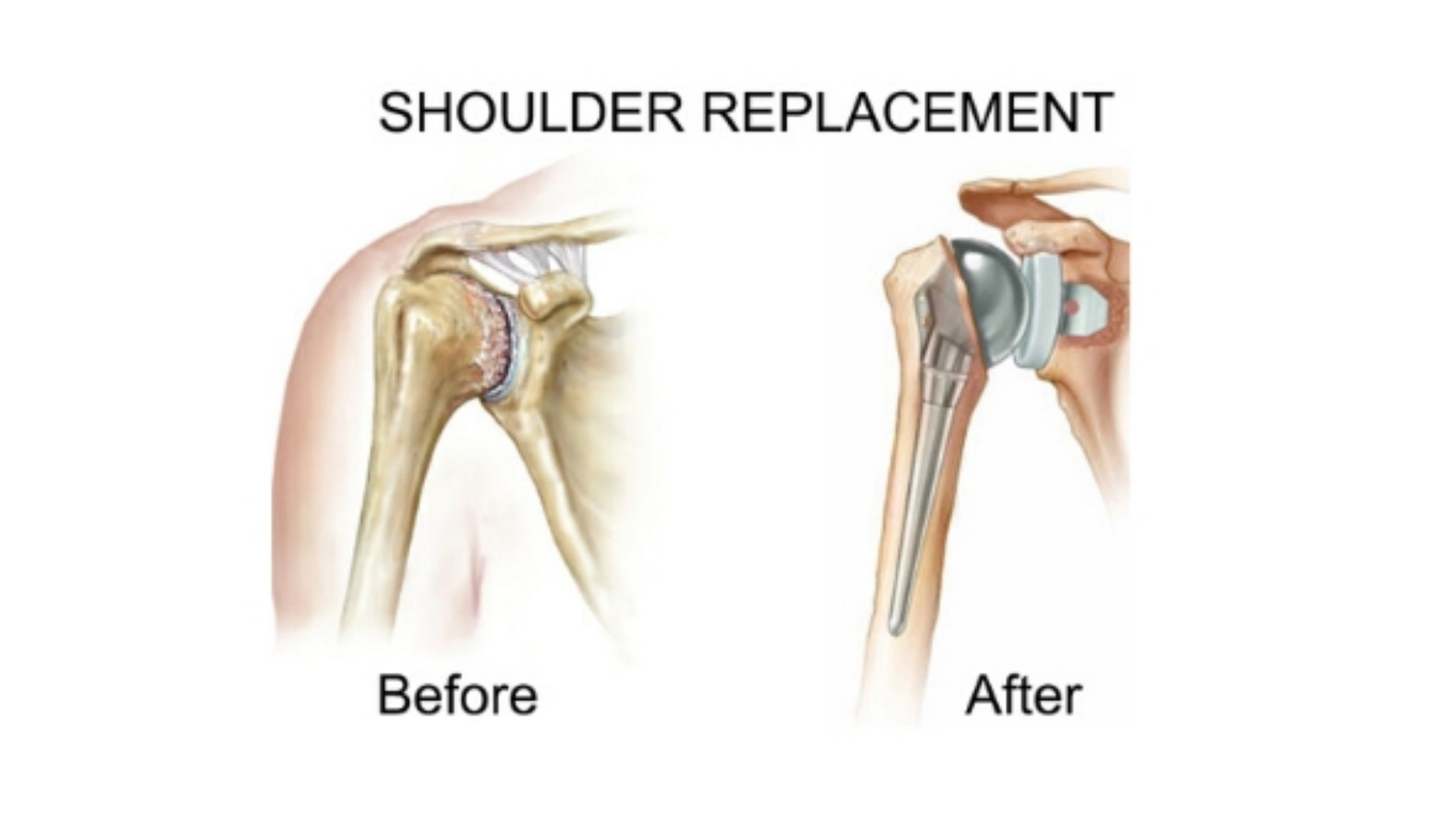 Dr. Hithesh explaining shoulder replacement surgery risks and benefits