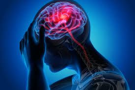 What Is Stroke