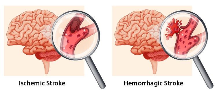Types of Stroke
