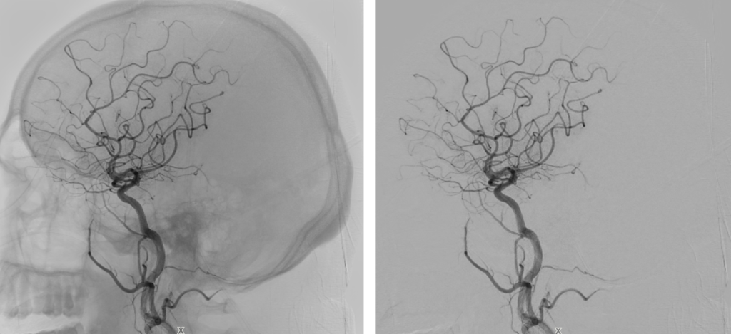 Digital Subtraction Angiography (DSA)
