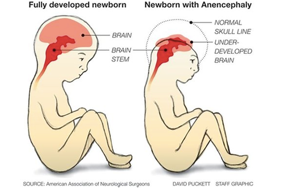 Birth Defects and Glyphosate Connection