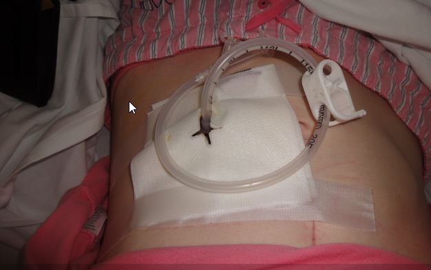 Glyphosate Found in Feeding Tube Liquid