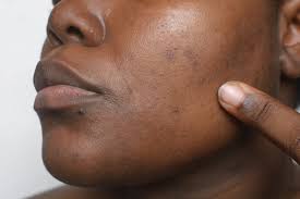 Hidden Clues: What Your Skin, Nails, and Eyes Reveal About Kidney & Gut Health