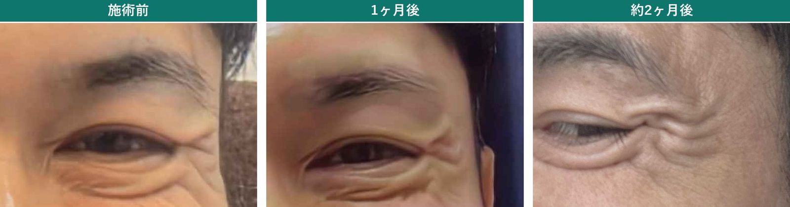 ボトックスの目尻の経過。施術前・1ヶ月後・約2ヶ月後の笑った目尻