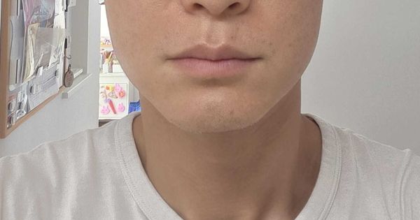 デンシティ52日目レポート。約7週間半、フェイスラインの締まりと肌質が定着してきた